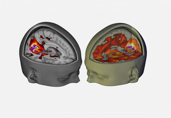brain scan on lsd users